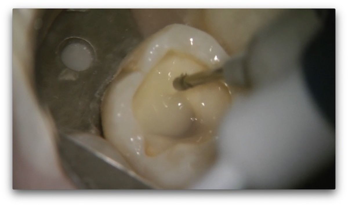 Restoration of endodontically treated molar a clinical case Dentistry33