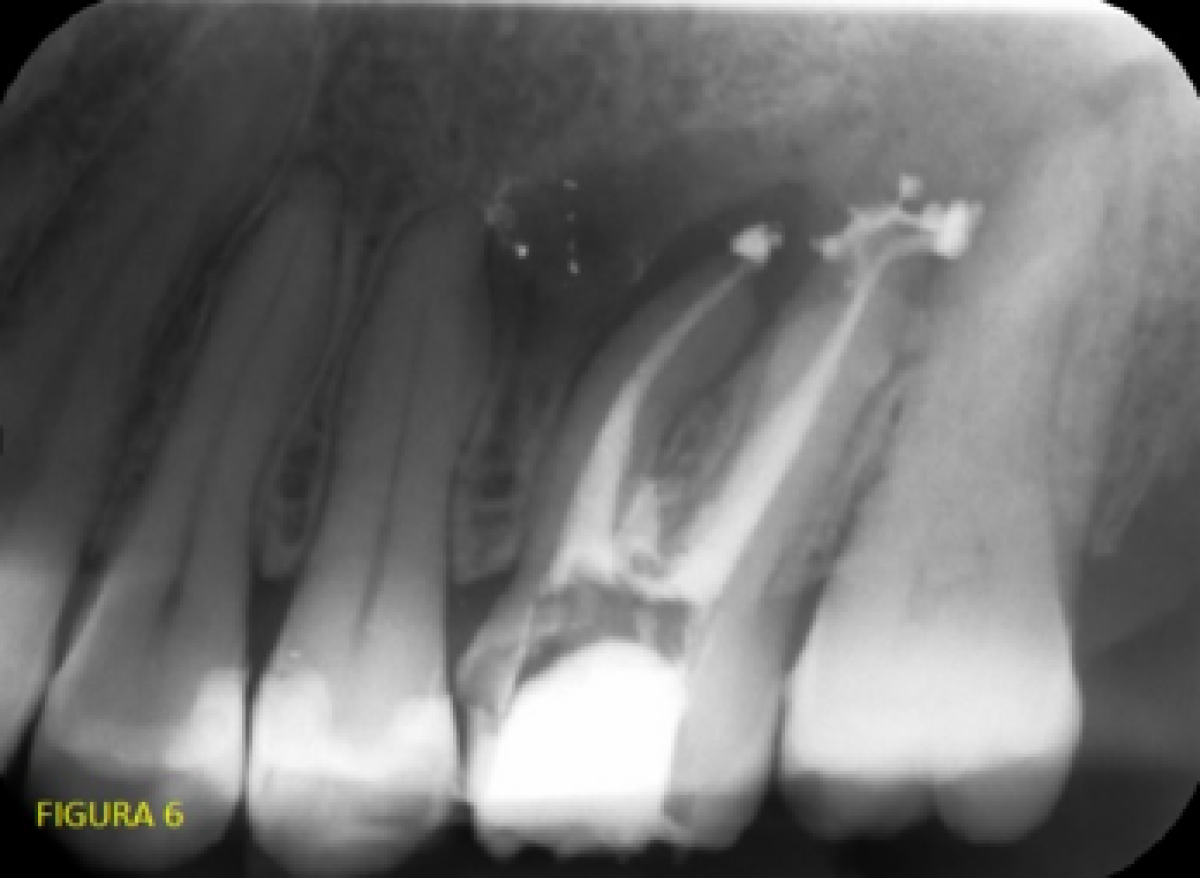 <p>                                    Fig. 6: end of canal treatment, control X-ray            <br></p>