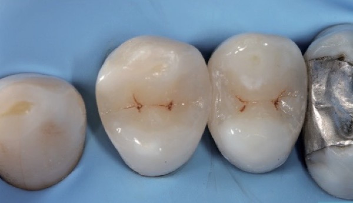 Fig 6: final restoration 1.4 and 1.5