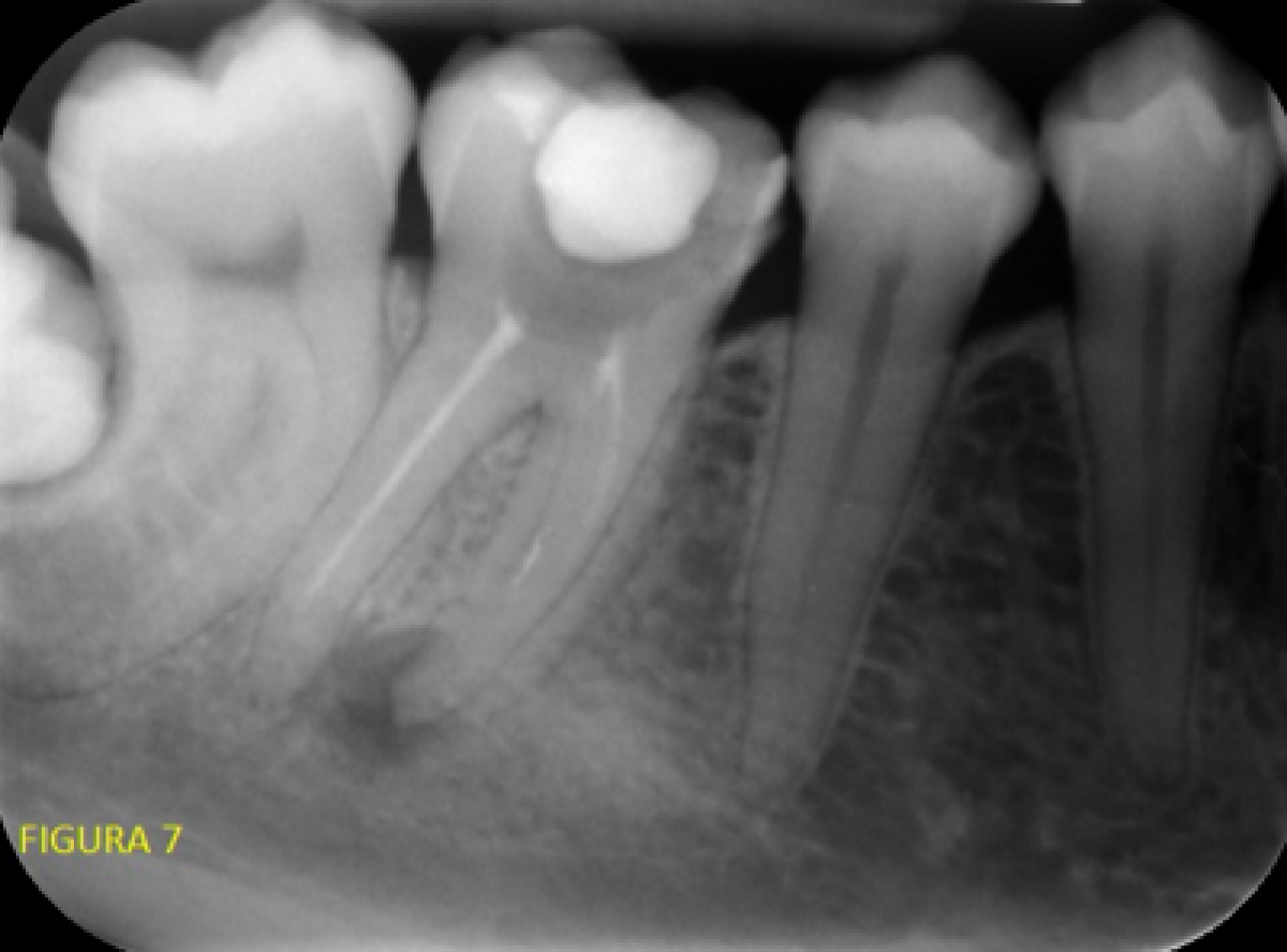 <p>                                    Fig. 7: Pre-op X-ray.            <br></p>