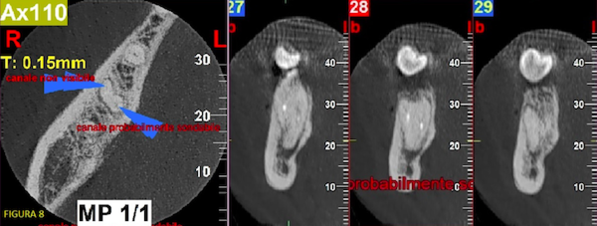 <p>                                    Fig. 8: cross-section 28 MI canal clearly visible apically at the end  of the root canal filling.            <br></p>