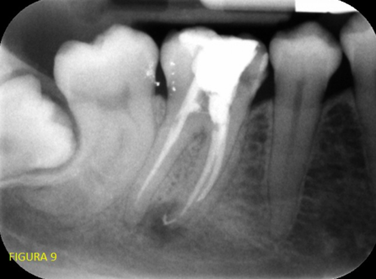 <p>                                    Fig. 9: Post-op control X-ray.            <br></p>