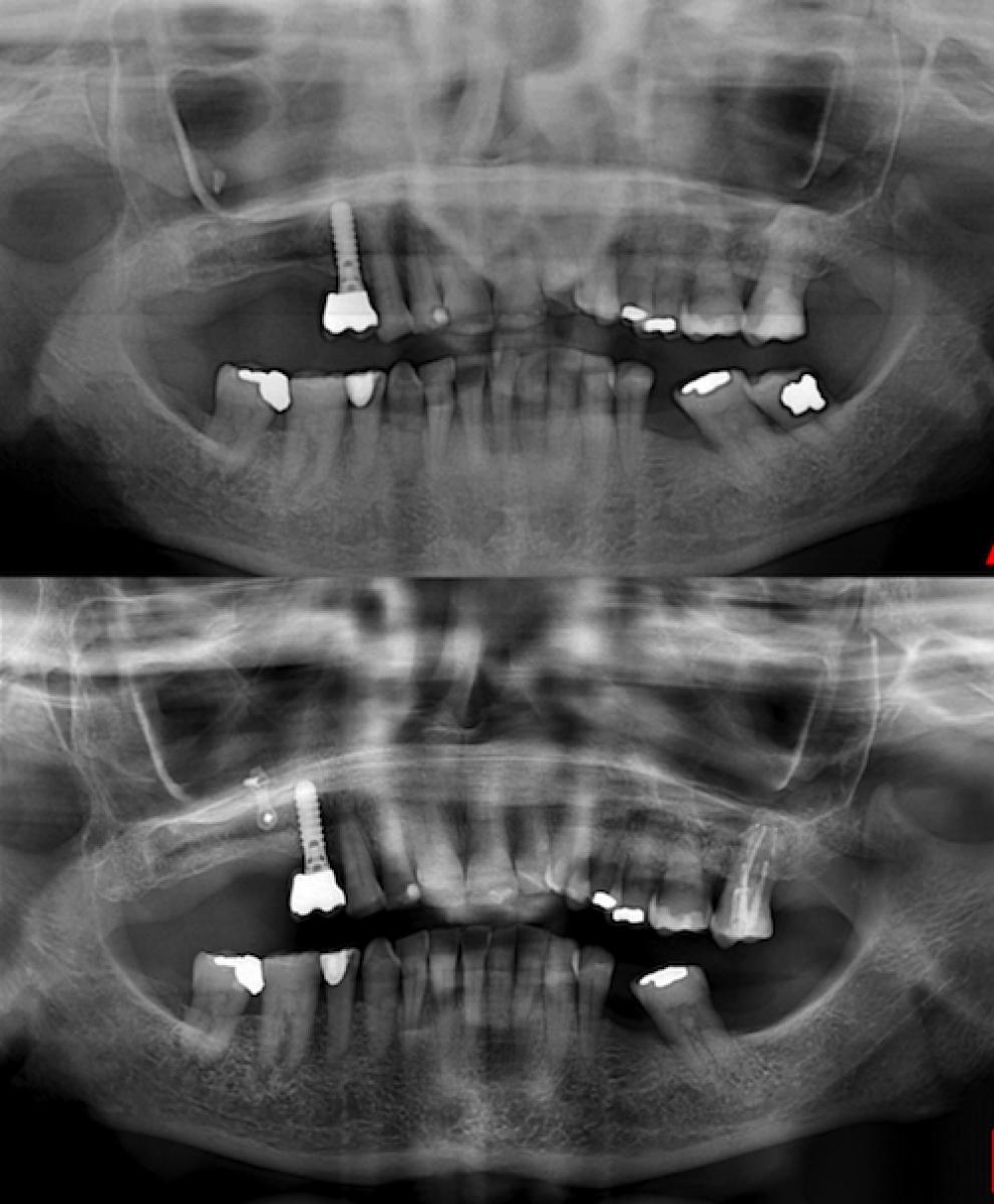 Fig. 1 Preoperative orthopanoramic radiography showing the presence of the fungus ball in the right maxillary sinus (a). Post-operative radiograph showing the healing of the right maxillary sinus and the presence of osteosynthesis plaque (b)