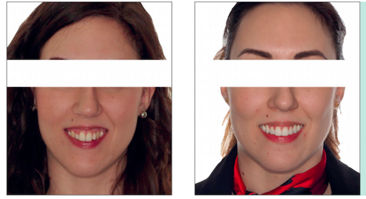 Orthodontic treatment to correct the gummy smile and biprotrusion a clinical case Dentistry33