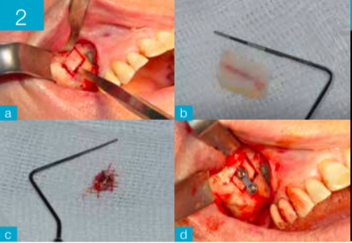 Figs. 2a-d Access hatch construction to the maxillary sinus (a, b). Removal of the fungus ball (c). Repositioning of the bone trap and fixation with osteosynthesis screws (d)