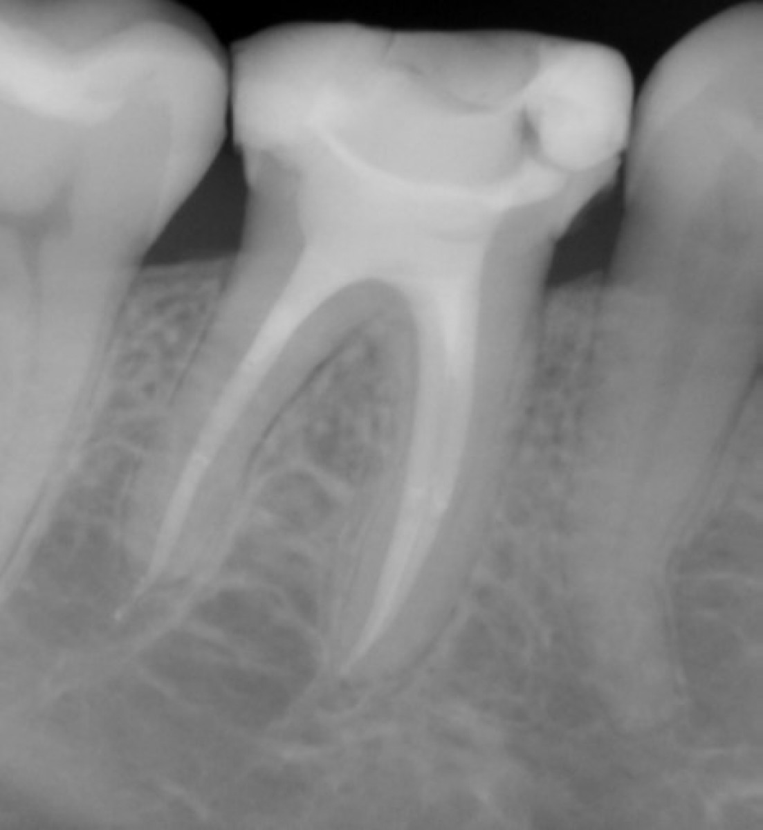 IrriFlex. Case Report The endodontic treatment Dentistry33