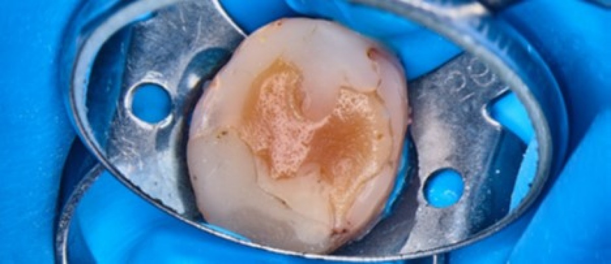 IrriFlex. Case Report The endodontic treatment Dentistry33