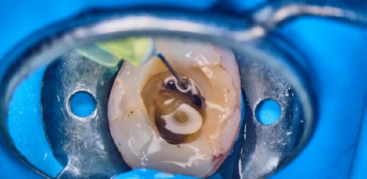 IrriFlex. Case Report The endodontic treatment Dentistry33