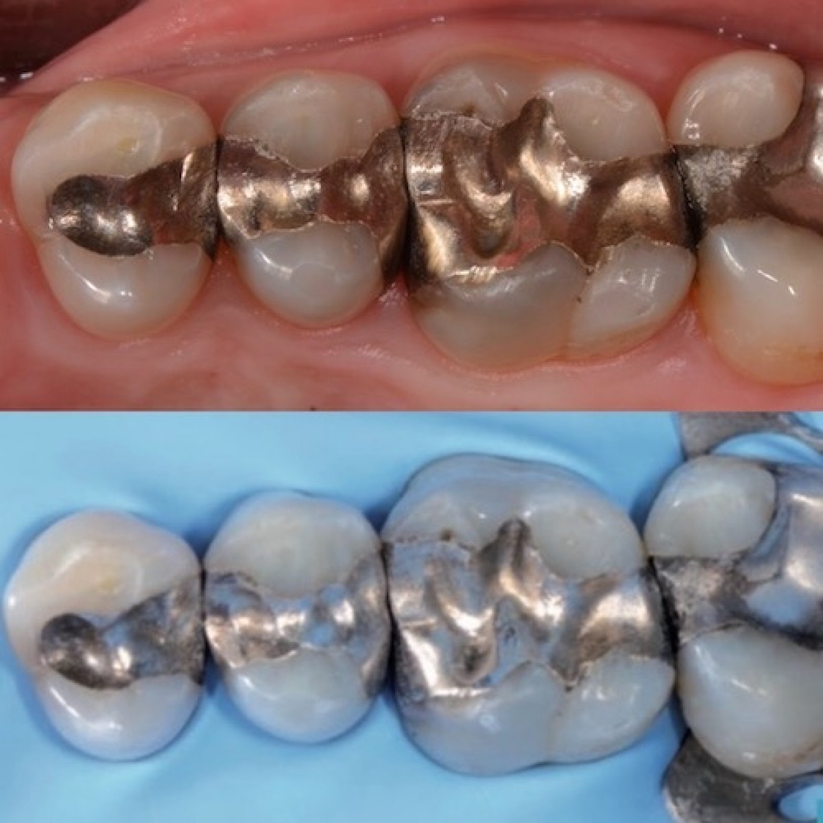 Fig 3a-b: pre- and post- isolation with dental dam 