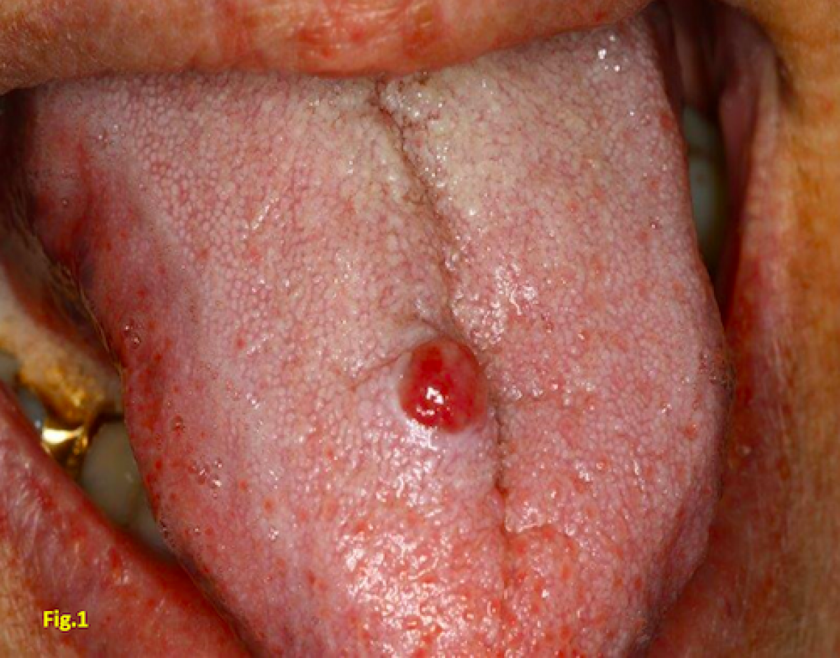 Fig. 1:  Red vermilion exophytic lesion on the back of the tongue