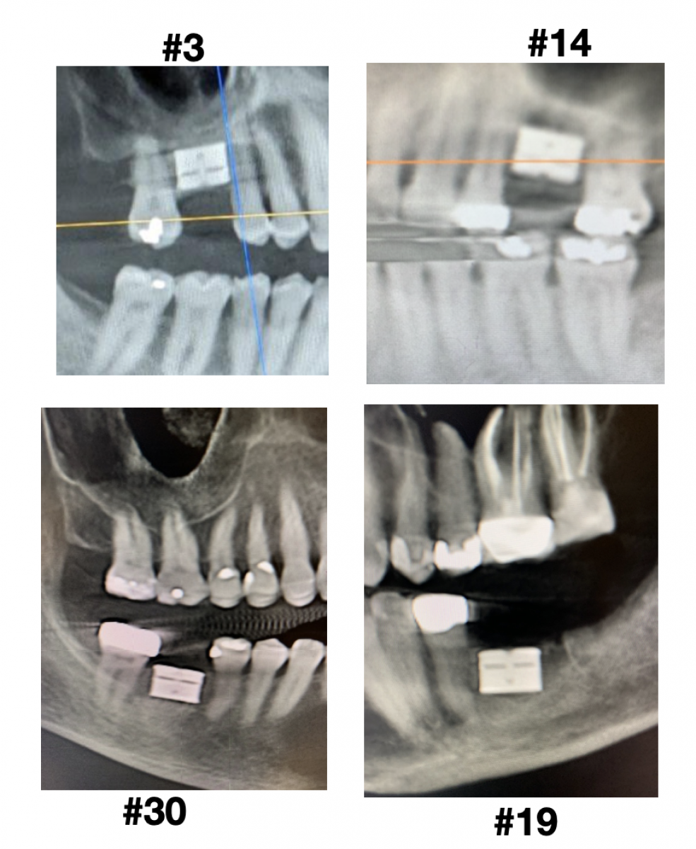 An x-ray view of the new implant. Grant's implant is #3.