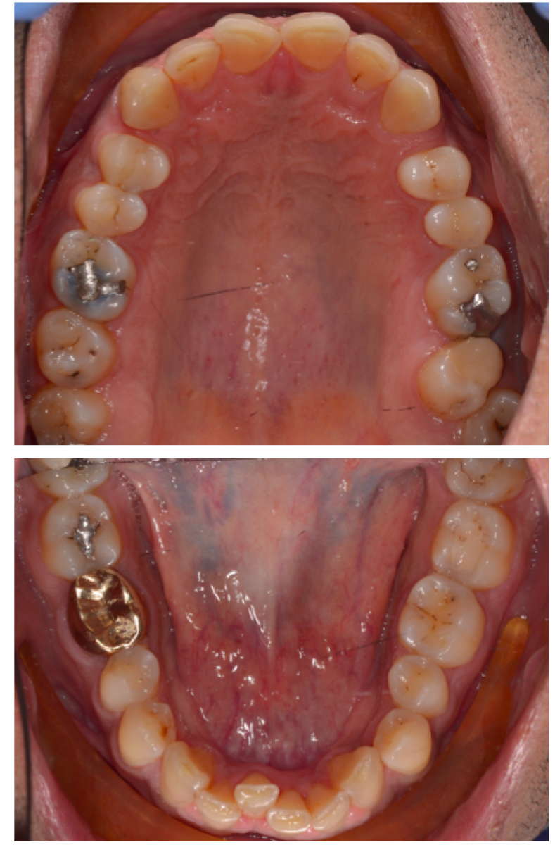 Initial intraoral situation