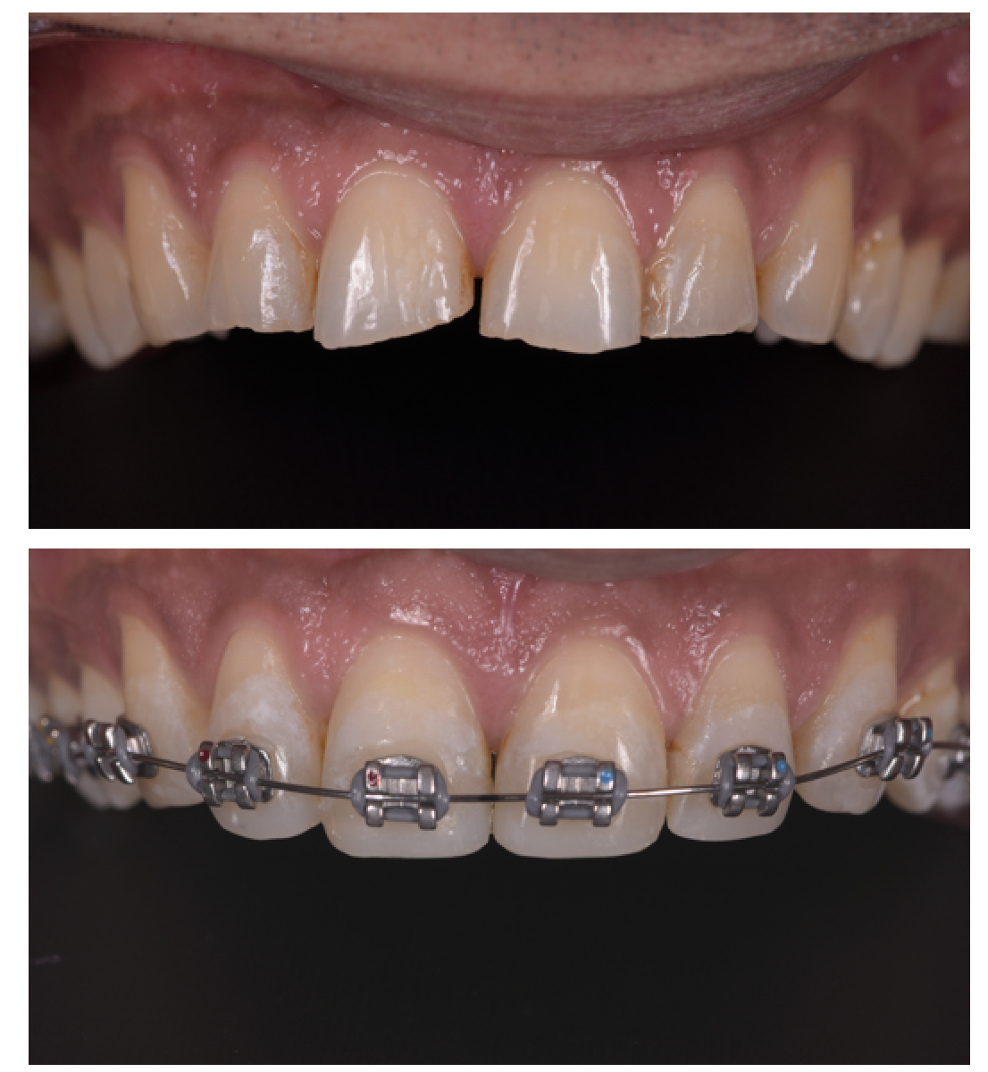 Provisional composite stage