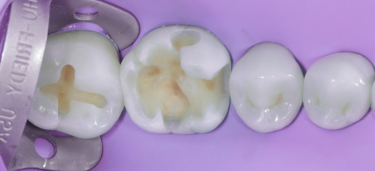 <p>                                    Fig 4 Completed  and finished cavity. The presence of fracture lines is excluded and thus the  presence of cracked tooth syndrome, which would have had a completely different treatment plan, is excluded.            <br></p>