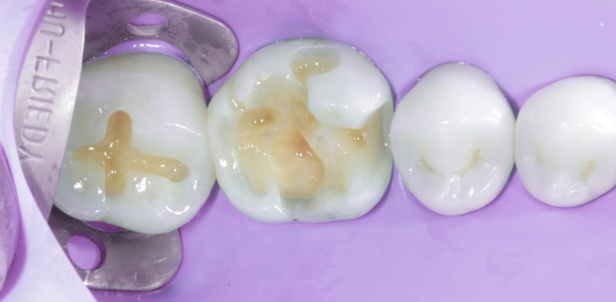 <p>                                    Fig 5 Application  of self-etch adhesive after pre-etching of the enamel (I bond self etch).            <br></p>