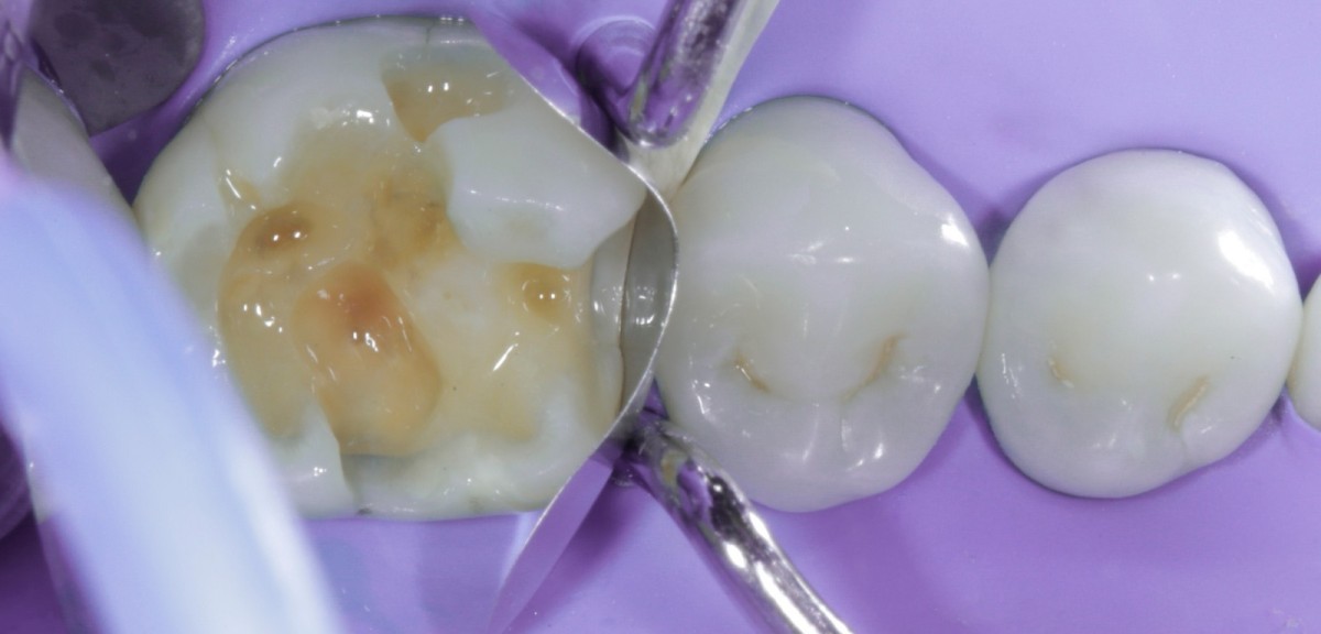 <p>                                    Fig 6 Insertion  of the sectional matrix that adapts optimally to the cervical step and  positioning of the wedge and ring.            <br></p>