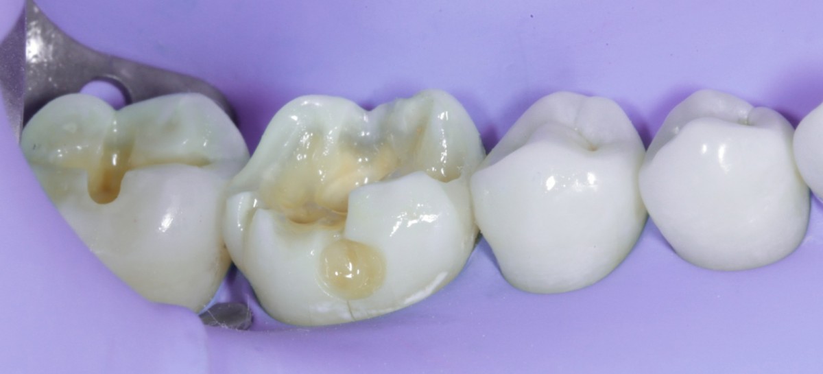 <p>                                    Fig 7 Lateral  view of the newly created interproximal wall.            <br></p>