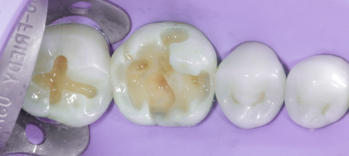 <p>                                    Fig 8 Occlusal  view of the interproximal wall and the presence of a correct contact point.            <br></p>