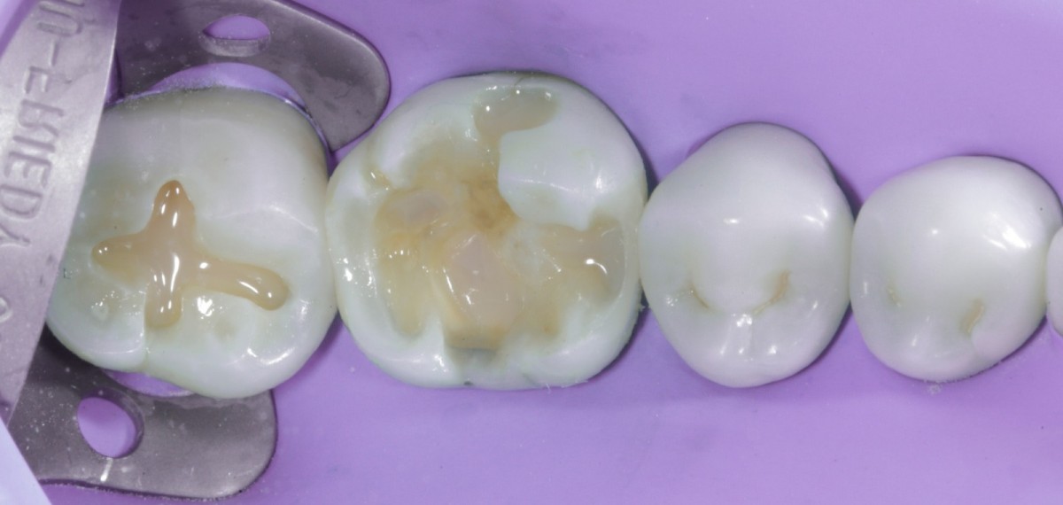 <p>                                    Fig 9 Deposition  of a thin layer of flowable composite (Venus diamond flow A1).            <br></p>