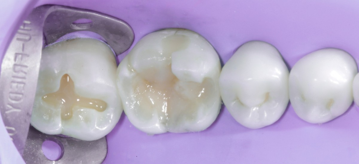 <p>                                    Fig 10 First  apposition with Venus Diamond one.            <br></p>