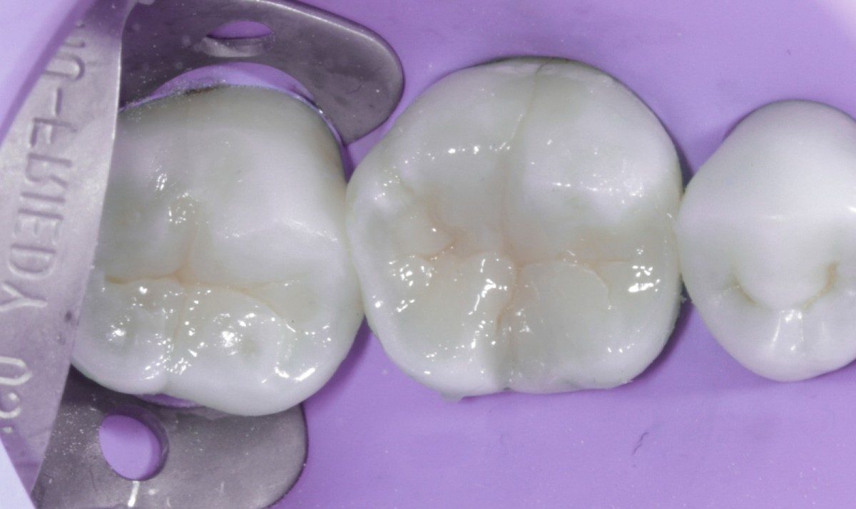 <p>Fig 11 Second apposition with Venus Diamond one and modeling of the complete occlusal table in a single stroke.<br></p>