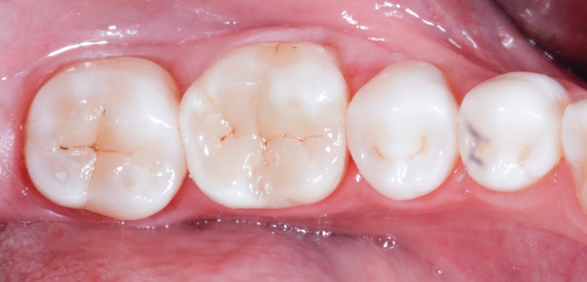 Fig 13 Occlusal aspect of the completed restorations.