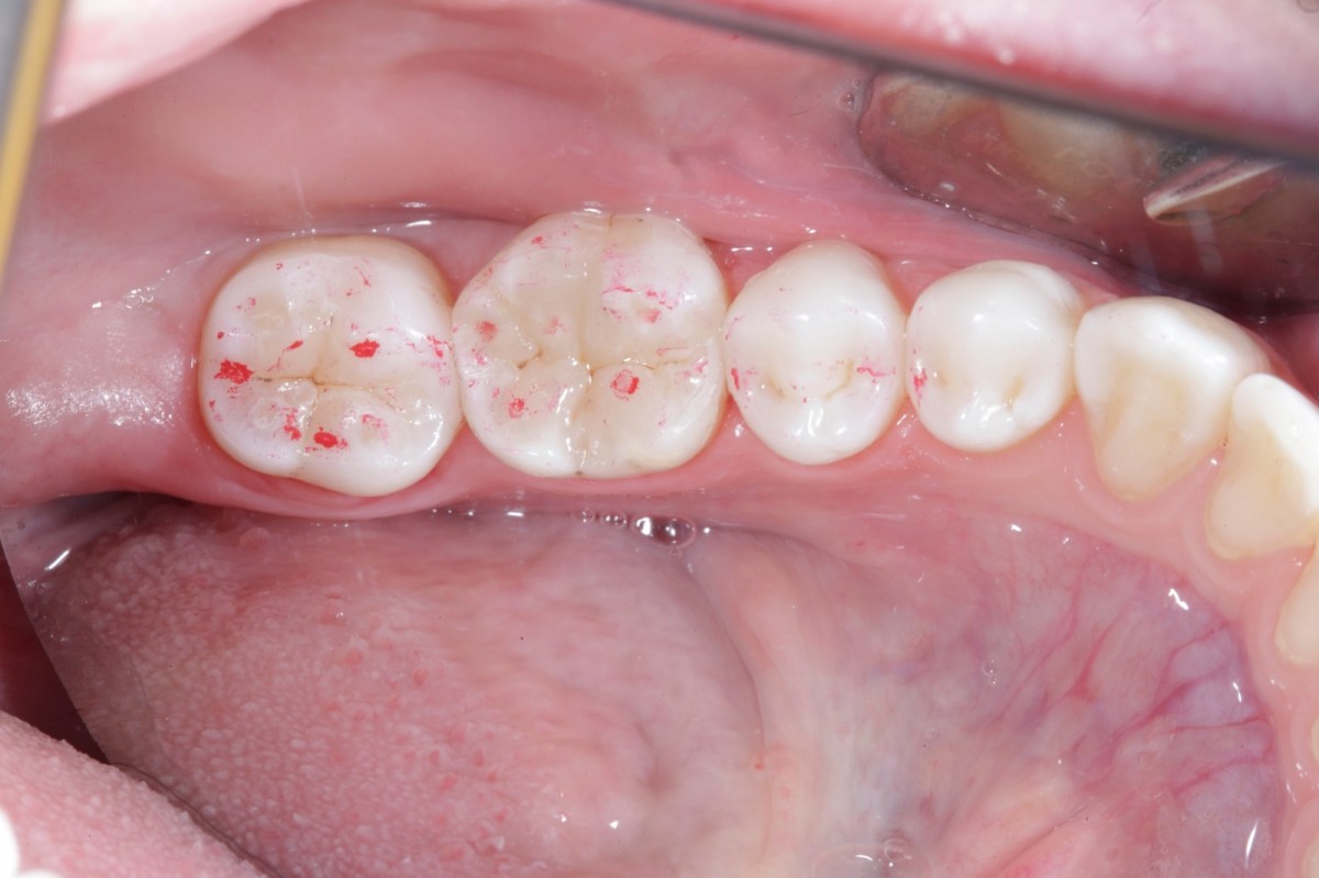 Fig 14 occlusal check.