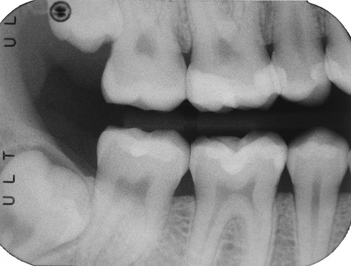 Fig 15 Final radiography