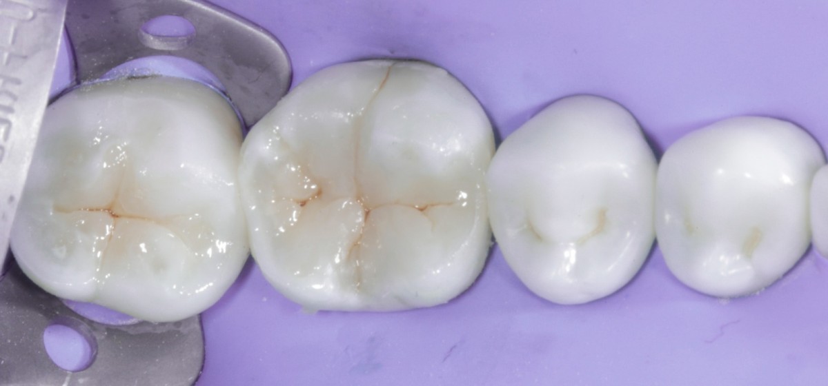 Fig 12 Use of intensive flowable composite (brown) to characterize the occlusale surface.