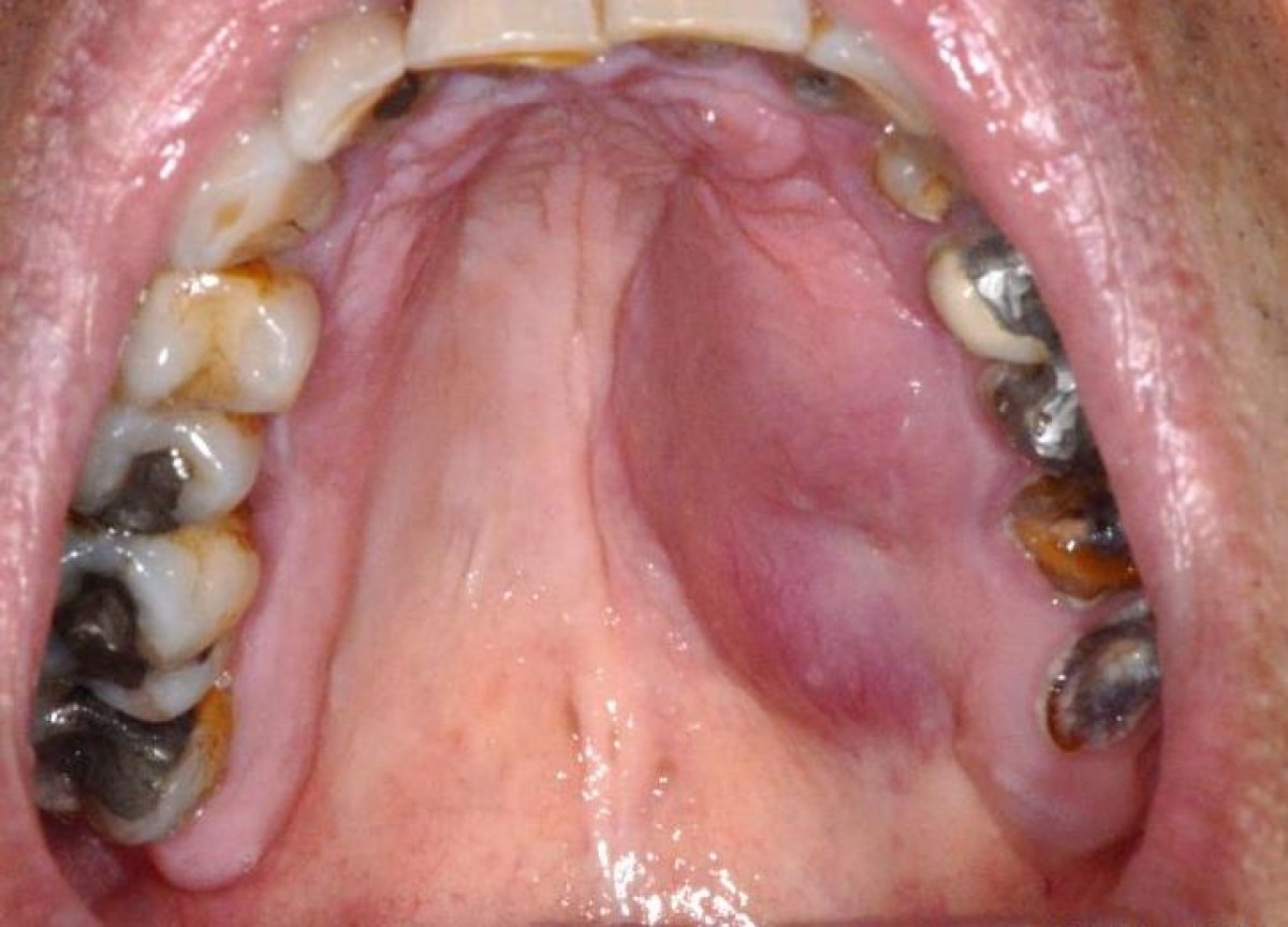 Fig. 1: Palatal swelling 