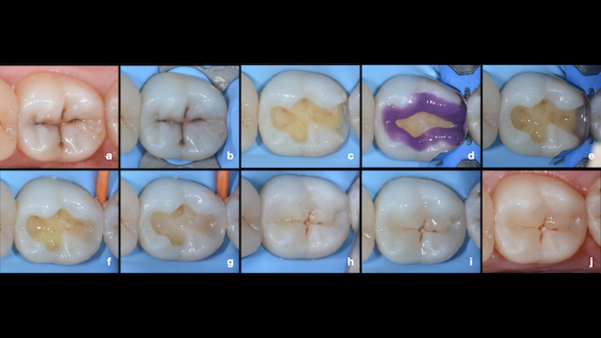 Figure 2: second restorative case from 