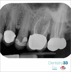 Fig. 1: periapical intraoral image.